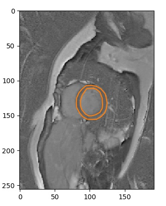 MRI image contoured